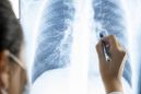 Lung function shows improvement at 12 weeks in COVID long-haulers, study finds
