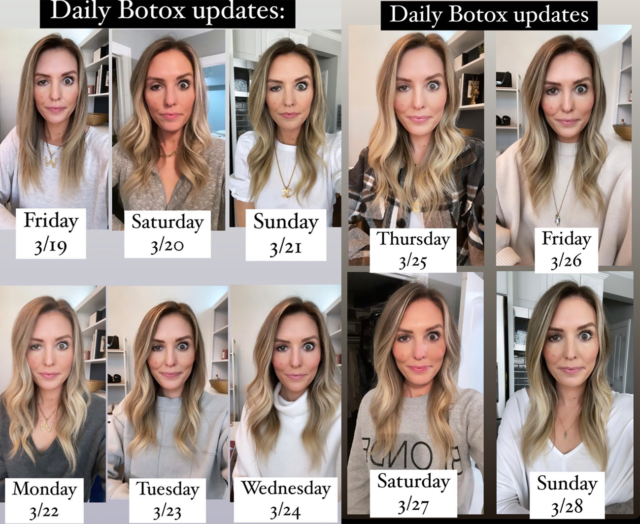 Influencer Documents Horrible Botox Gone Wrong Situation That Left Her Bug-Eyed!