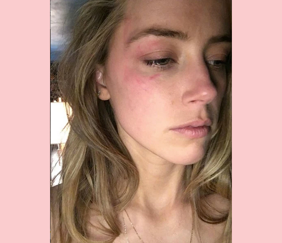 Amber Heard hit with phone bruise