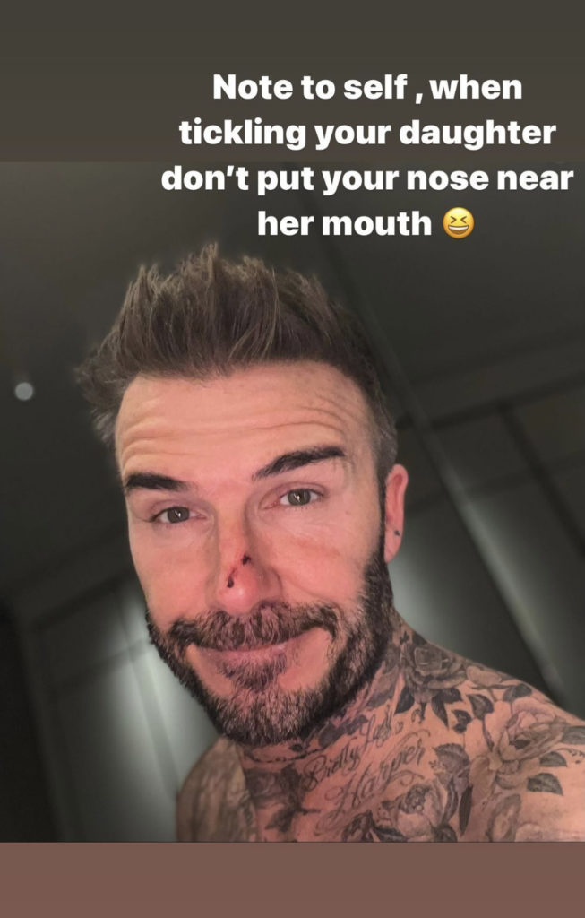 Ouch! David Beckham Reveals Bloodied Face After Daughter Harper BIT Him While He Tickled Her!